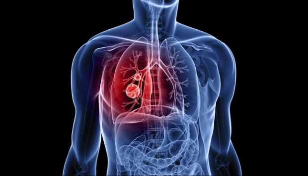 Mengenal Hipertensi Pulmonal Yang Berbahaya Bila Tidak Segera Ditangani!